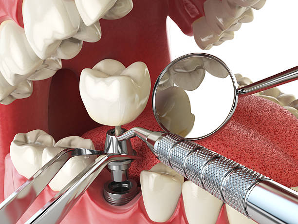 Best Emergency Dentist for Lost Fillings or Crowns in Shippensburg, PA
